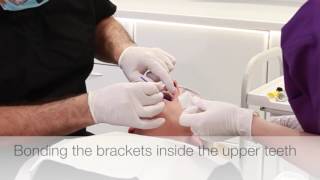 Fitting Hidden Incognito Braces at Andrea Ubhi Dentistry with Dr Remo Costi