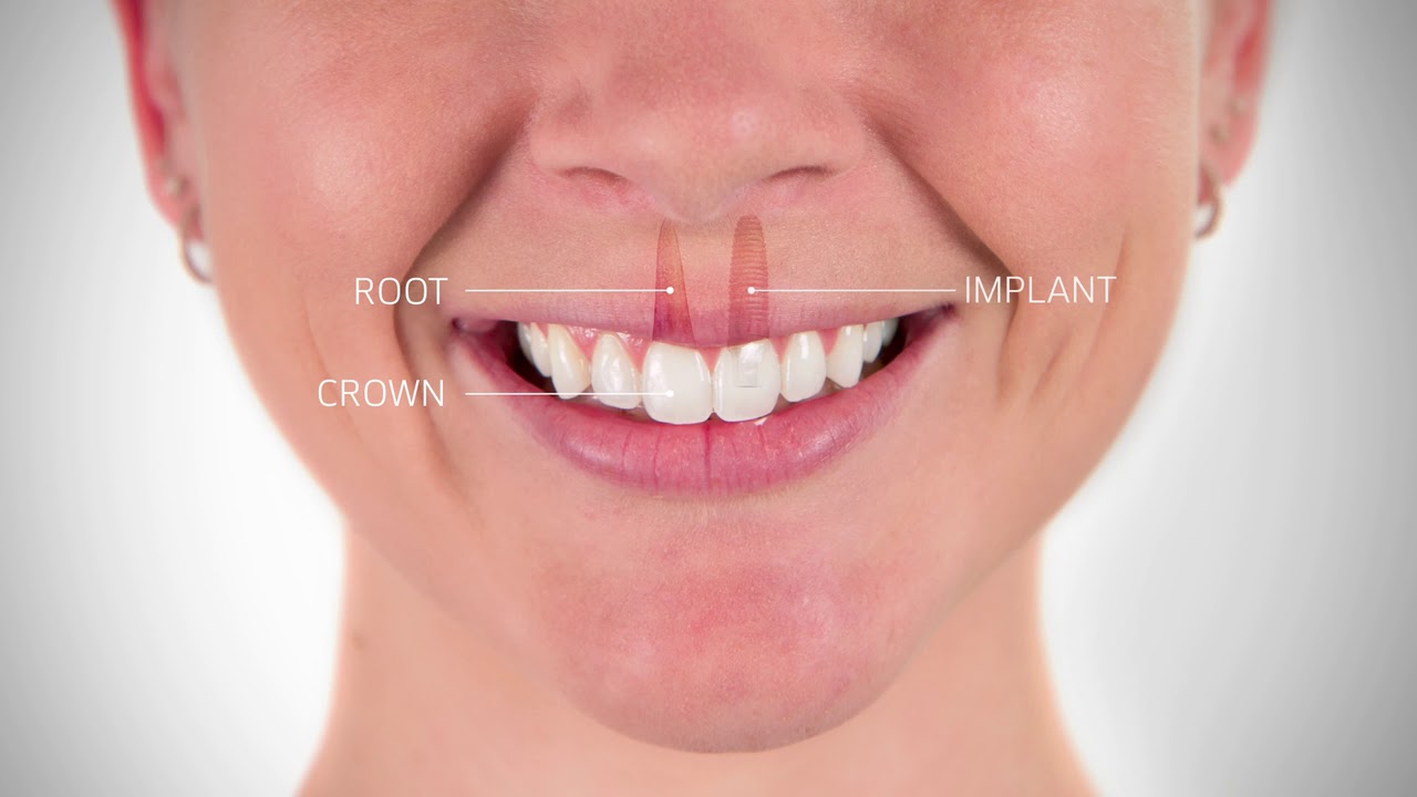 About Dental Implant Youtube