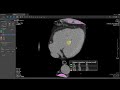 vitrea demonstrations cardiac calcium score