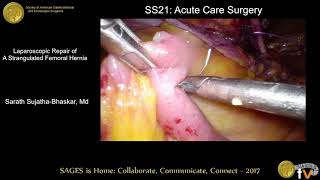 Laparoscopic repair of a strangulated femoral hernia