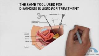 ARC Endometriosis