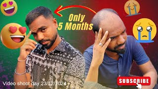 Mind Blowing Result 🥰😍 Only After 5 Months 🥳 // HAIR TRANSPLANT // D2LIFE VLOGGING