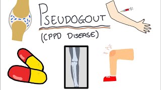 Pseudogout (Calcium Pyrophosphate Disease) - Simple and easy to understand