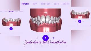 Smile direct club 5 mouth plan 💜 before and after