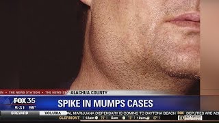 Mumps outbreak near University of Florida