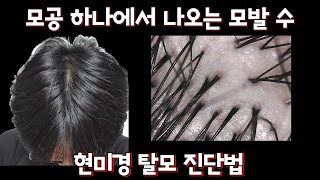 현미경으로 두피 진단 \