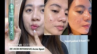 REVIEW NEW SKINTIFIC 3X ACID INTENSIVE ACNE SPOT | Hasil Berapa lama ?!