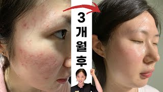 홍조, 좁쌀여드름 100만원으로 치료 가능?  소의티켓ep4)