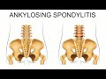 Learning about Ankylosing Spondylitis