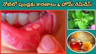 mouth ulcers control with home remedies in telugu ll నోటిలో పుండ్లకు కారణాలు \u0026 హోమ్ రెమిడీస్ l honey