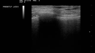 Lung Pulse in ecografia toracica