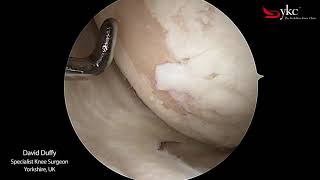 What Does Arthritis of The Knee Joint Look Like?