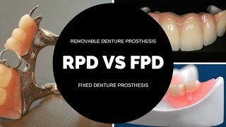 FPD VS RPD - dentures versus bridges