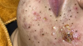 Big Cystic Acne Blackheads Extraction Blackheads \u0026 Milia, Whiteheads Removal Pimple Popping # 1715