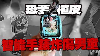 智慧手錶爆炸！10歲童燒燙傷恐植皮　業者：第1代需換電池｜電子產品｜HEROWATCH｜故障