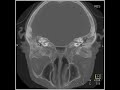 3d imaging of the internal auditory canal with thin section slab imaging