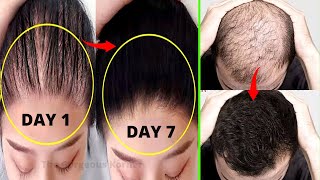 गंजेपन को दूर करे सिर्फ 7 दिन में - बालो को बड़ा और घना करने का आसान तरीका | Hair Growth Tips