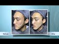 indiba® proionic facelift therapy facial for him ceramique aesthetics singapore