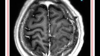 Neurocirguia oncologica pediatrica,  tratamiento de fluorescencia intraoperatoria