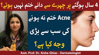 How To Get Rid Of Acne/ Pimples | Chehre Ke Dane Khatam Karne Ka Tarika |  Acne Treatment Ilaj