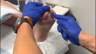 Hammertoe Correction | Flexor Tenotomy: A Satisfying Crunch that’s unexpected 🫠🎧