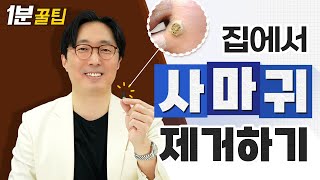 [1분꿀팁] 집에서 직접 사마귀 제거, 치료하기