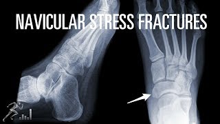 How can you quickly recover from a navicular stress fracture?