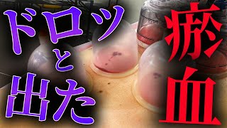 【閲覧注意 吸い玉 鍼灸治療】瘀血ヤバいのが出た 激務で腰がヤバい吸い玉と鍼灸治療で治す　自宅でできる方法も伝授 【横浜元町　銀座日本橋　鍼灸院】