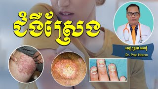 ជំងឺស្រែង-TINEA