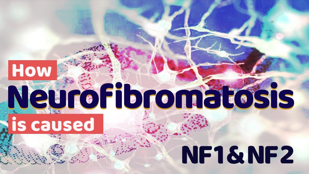 How Neurofibromatosis Type 1 And Type 2 Is Caused Nf 1 Nf 2 Youtube