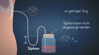 Die Vorteile von reguliertem Sog in einem Drainagesystem: physikalisch erklärt für Ärzte und Pflege