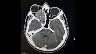 Fungal sinusitis.