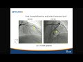 cvi 2019_saturday 7 20_ innovations in pci part 2 back to the basics_m. chadi alraies md mph