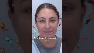 PET FACE LIFT (the magic behind this amazing procedure) #shortvideo