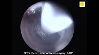 Neurosurgery video endoscopic aqueductoplasty