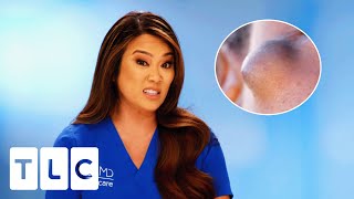Dr Lee Removes A “Cherry Tomato” Sized Cyst From Woman's Face |  Dr Pimple Popper | CENSORED