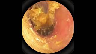 A Mountain of Earwax – Watch It All Get Extracted!