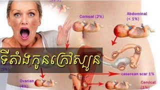 ទីតាំងរបស់កូនក្រៅស្បូន location ectopic pregnancy by Dr.Bun laysophea