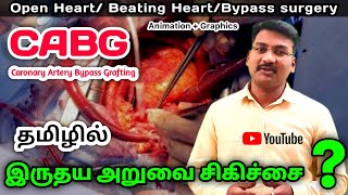 Open Heart Surgery in tamil|CABG in tamil | beating heart | bypass surgery | grafting |ps tamil