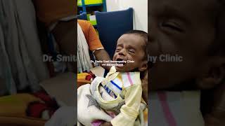 Improvement in Hydrocephalus by Homeopathy Treatment