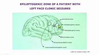 AES 2023 Epilepsy Specialist Symposium | The Frontal Lobe: Bermuda's Triangle