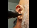 hair removal from the ear#1