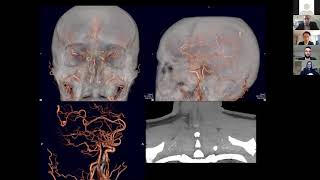 Brain Arteriovenous Malformations (AVMs) and Hereditary Hemorrhagic Telangiectasia (HHT)