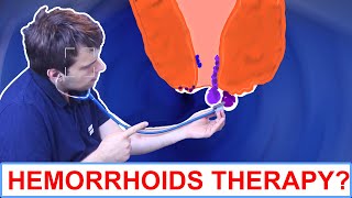 4 Things To Do About Hemorrhoids