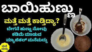 ಎರಡೇ ದಿನದಲ್ಲಿ ಬಾಯಿಹುಣ್ಣು ಕಡಿಮೆ ಆಗ್ಬೇಕಾ? ಪವರ್ ಫುಲ್ ಮನೆಮದ್ದು | Amazing Home Remedy for Mouth Ulcer