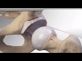 Hip Labral Repair With 2.4 mm Mini Hip PushLock® Anchors