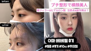 【横顔ブサイク解消】韓国人美容YouTuberのおでこフィラー\u0026ヒアルロン酸体験。注意点や副作用は？【プチ整形】