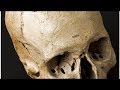 What Is Trepanation?