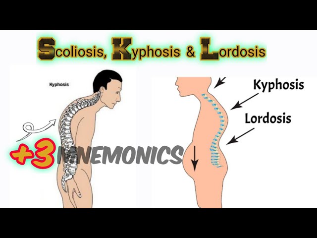 Lordosis Kyphosis Scoliosis