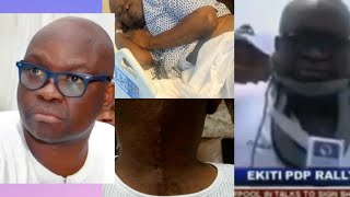 FORMER EKITI STATE GOVERNOR, FAYOSE UNDERGOES SURGERY